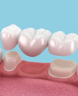 All Porcelain Dental Bridge - Bell Family Dental in Bayside, NY