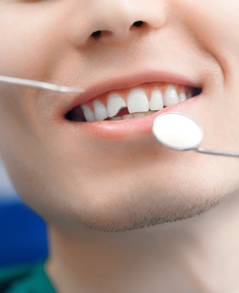 Chipped Tooth - Bell Family Dental in Bayside, NY
