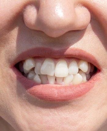Crooked Teeth - Bell Family Dental in Bayside, NY