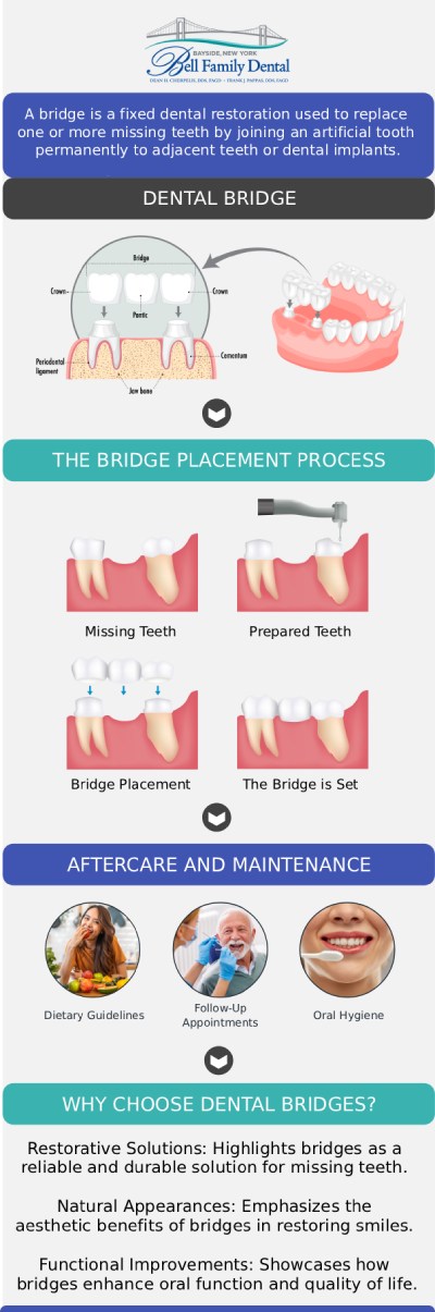 Common questions asked by patients: What is an all-porcelain dental bridge? How long does it take to get a dental bridge? How long do porcelain dental bridges last? How do I care for my new dental bridge? Is a custom dental bridge from Bell Family Dental the right choice for my smile? For more information, contact us or request an appointment online. We are conveniently located at 33-03 Bell Blvd, Bayside, NY 11361.