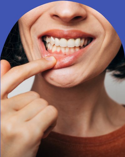 Bleeding Gums - Bell Family Dental in Bayside, NY