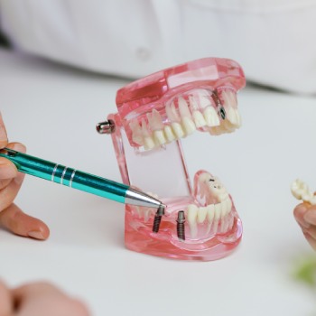 When to Consider a Dental Implant