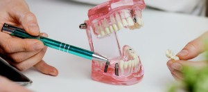 When to Consider a Dental Implant? | Bell Family Dental in Bayside, NY
