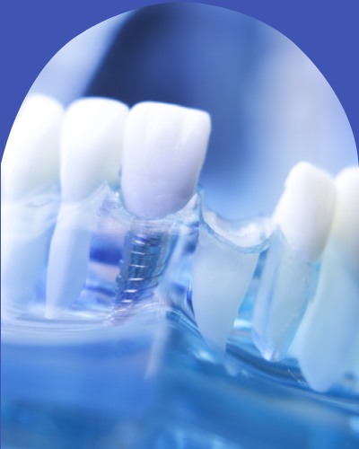 Missing Teeth - Bell Family Dental in Bayside, NY