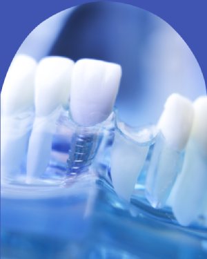 Missing Teeth - Bell Family Dental in Bayside, NY