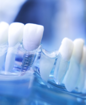 Missing Teeth - Bell Family Dental in Bayside, NY