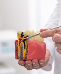 Root Canal Treatment - Bell Family Dental in Bayside, NY
