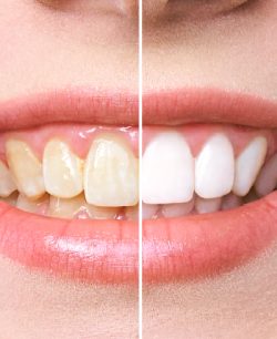 Stained Teeth - Bell Family Dental in Bayside, NY